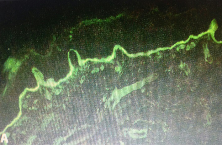 Figure 7: DIF showing linear deposits of IgG and C3.