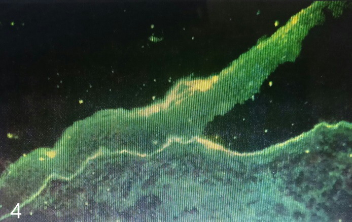 Figure 8: Salt split preparation showing IgG and C3 deposition on the floor of the bulla.