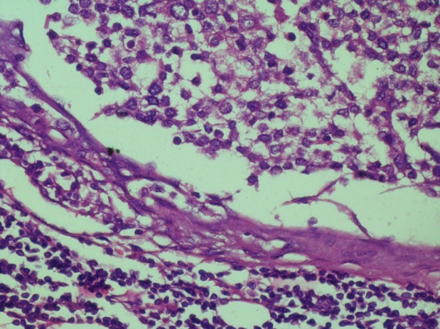 Figure 14: IDC with vascular invasion: Section shows tumour nests infiltrating the vessel. H&E X 10 X.
