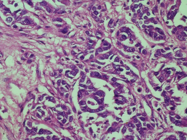 Figure 15: IDC: Section shows nests & glands of tumour cells with mild anisonucleosis & scant eosinophilic cytoplasm infiltrating the stroma. H&E X 40X.