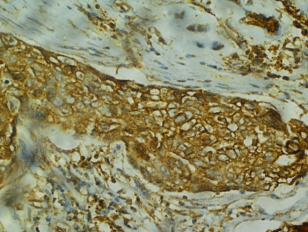 Figure 17: IHC Her2/neu: Section shows marked uniform & complete membranous staining of tumour cells. Score3+.IHCHer2/ NeuX40X.