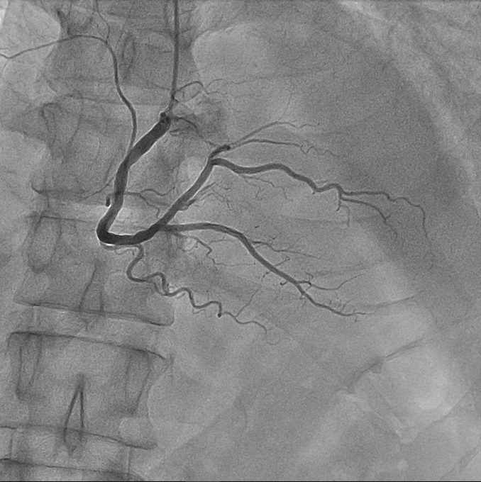 Figure 3: Intact coronary arteries on the right coronary artery.