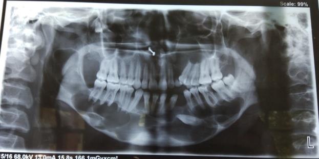 Figure 3: Multiple OKCs in both Maxilla.