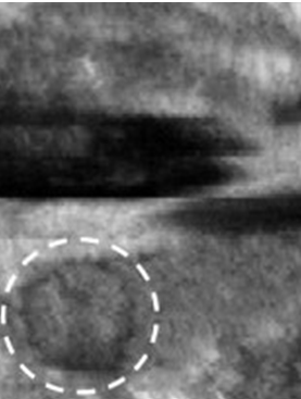Figure 1: A 2 cm-sized hypoechoic mass on ultrasonography.
