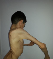 Figure 4: Severe dorsolumbar scoliosis.