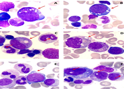 Figure 3: In MDS, dysplasia may involve one or more hematopoietic series that means HSCs clonal expansion. The maturation is abnormal (dysplastic) and production ineffective resulting in many cells being ruined before the cells reach to the systemic circulation [22-26].