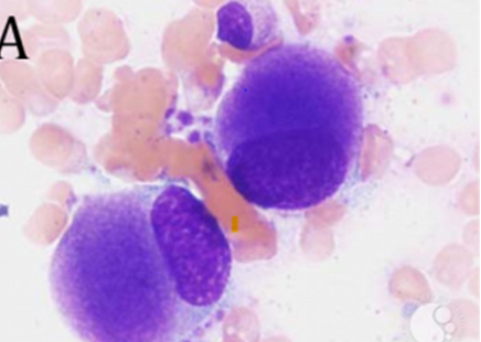 Figure 5: Diagnostic findings in 5q- syndrome: A) Hypo-lobulated megakaryocytes B) Note loss of material from chromosome 5 long arm [22,28].