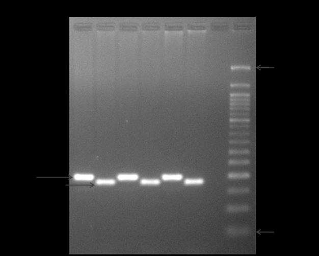 Figure 1: Further, when 25 pre-therapeutic blood samples of CRC patients were subjected to DPYD IVS14+1 G>A polymorphism analysis, the distribution of genotypes was observed to be similar between tumor and pre-therapeutic blood samples. Additionally, this polymorphism was evaluated in peripheral blood of healthy individuals (N=25) and the frequency of wild type G/G genotypes was 100% in all healthy individuals. Thus, present study could not identify any of the heterozygous variant G/A genotype or homozygous variant A/A genotype for DPYD IVS14+1 G>A polymorphism in both CRC patients and healthy individuals.