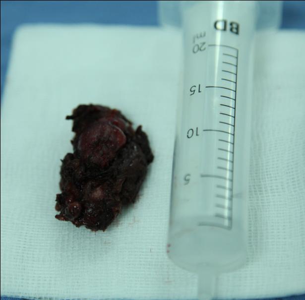 Figure 4: Right thyroid lobule and isthmus.