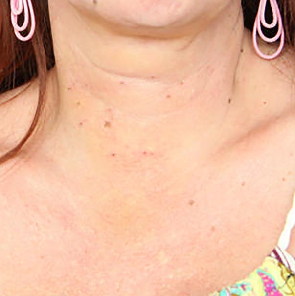 Figure 5: Postoperative day 3, no scar or wound visible in patient’s neck.