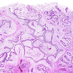 Figure 1: Uterine Adenosarcoma demonstrating fascicles of spherical to elliptical tumour cells imbued with moderate, pale cytoplasm, vesicular nuclei and prominent nucleoli surrounded by an oedematous stroma. The sarcoma component is superimposed with benign glandular epithelium. Mitotic figures are observed [6].