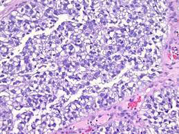 Figure 2: Clear cell adenocarcinoma delineating glandular structures lined by hobnail cells and clear cells permeated with clear cytoplasm, hyaline globules, nuclear atypia and enhanced nucleocytoplasmic ratio. Mitosis is minimal, Intervening stroma is scanty [7].
