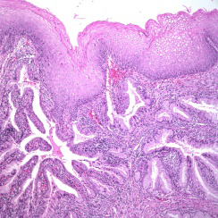 Figure 1: Minimal deviation adenocarcinoma composed of infiltrative glandular articulations layered by tall, columnar mucus secreting epithelium imbued with abundant, eosinophilic cytoplasm, basal, hyperchromatic, pleomorphic nuclei, vesicular chromatin and prominent nucleoli. Desmoplastic stroma is minimal.
