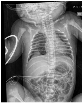 Figure 1: Initial chest x-ray on admission showed right small pneumothorax.