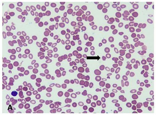 Figure 1: Patient with chronic kidney disease shows many crenated cells (echinocytes) (MGG stain, 200x).