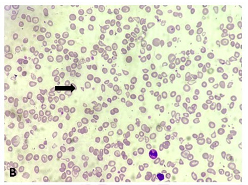 Figure 2: Patient of TTP shows presence of fragmented RBCs and schistocytes (Leishman stain, 200x).