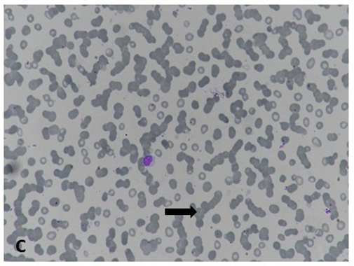 Figure 3: Patient of plasma cell myeloma showing rouleaux formation (Leishman stain, 400x).