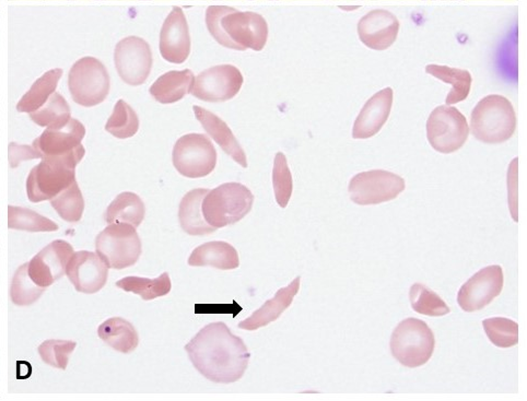 Figure 4: Patient with sickle cell disease illustrates sickle cells and polychromatophils (MGG stain, 400x).
