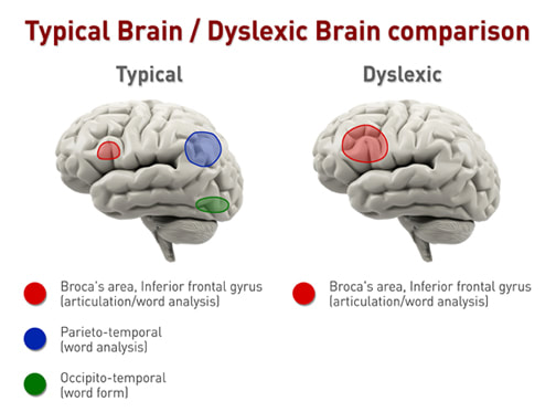 Figure 2: Credited to Marci Peterson: https://www.marcipetersonet.com/what-is-dyslexia.html From the above diagram Figure 1 we name the Dyslexic reader as A and the efficient reader as B. This prognosis is assumed because we do not certainly know yet what necessitates the composition of the brain of the one with dyslexia to differ from the one without it. It is very obvious that there is no difference in structure between A and B. However there are apparent areas that fire in the brain of B, which does not fire in A. To outline this area, a look is given to Figure 2. In this we can refer to the typical as 1 and the dyslexic as 2. In 1, there are three regions as much as B in figure 1 that comes alive when the brain of non-dyslexic is engaged in reading and understanding. They include the Broca Area, the Inferior gyrus, the parieto-temporal and occipito-temporal areas. It is of great value to notice that that of the Broca area (the inferior gyrus) is not as enlarged as it is in that of the dyslexic (as seen in 2 of figure 2). What this implies is that the dyslexic involves more effort in trying to level up with those that are his or her peers. This would prove to be near impossible because the other areas that are supposed to come alive when reading, comprehension and the likes are engaged in are dormant.