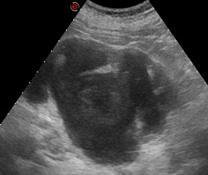 Figure 1: Abdominal ultrasound, left kidney. Marked hydronephrosis with dilation of the renal pelvis and calyces, hyperechogenic mass in the left renal pelvis. Antibiotical treatment was initiated and the ultrasound image of the left kidney showed no dynamics after 5 days of intravenous antibacterial therapy (figure 2).