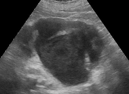 Figure 3: Contrast-enhanced abdominal CT. (A) Native scan – left-sided hydronephrosis. (B) Contrast-enhanced CT – left- sided hydromephosis, no excretion of the contrast medium by the left kidney, mild accumulation of the contrast medium in the cortex of the left kidney. (C) Intravaginal pessary. (D) and (E) Coagulum in the urinary bladder – mobile when body position is changed.