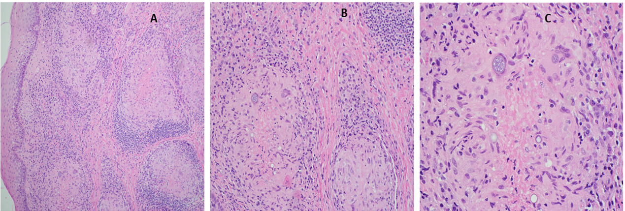 Figure 1: Representative photomicrographs of the left vocal cord lesion. A. Low power view showing squaumous mucosa with well formed granulomas. B. At high power, the granulomas contained spherulus and endospores, surrounded by mixed inflammatory infiltrate. C. At high magnification, large spherical fungal forms with eosinophilic wall and multiple basophilic endospores can be identified. (H&E stain; original magnification, x 40 [A], x 200 [B], x 400.