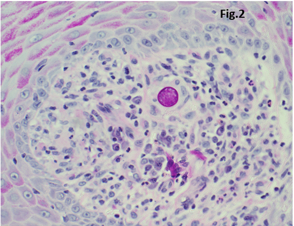 Figure 2: Special stain characterization of fungi. PAS stain shows fungal spherule with thick wall (original magnification, x 400).