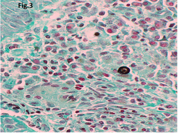 Figure 3: GMS stain identifies fungal spherule (GMS stain; original magnification, x 400).