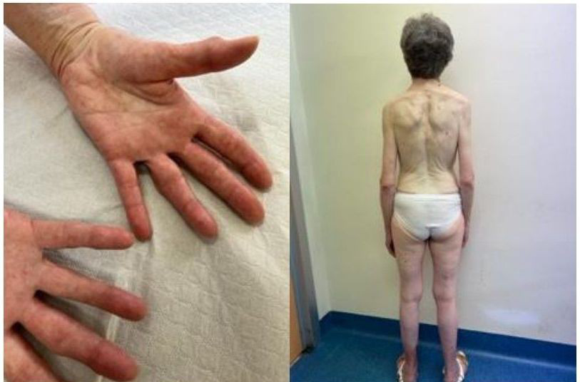Figure 1: On the right palmar plantar tips. On the left back view of the patient’s habitus.