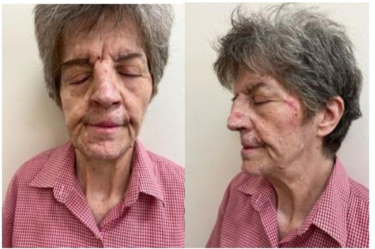Figure 2: Basal cell carcinomas of the nose, nasogenial region, chin and frontotemporal region.