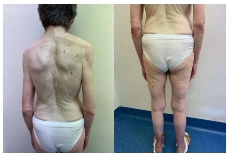 Figure 3: Basal cell carcinomas of the trunk and lower limbs. On the right, Sprengel anomaly of the scapula.