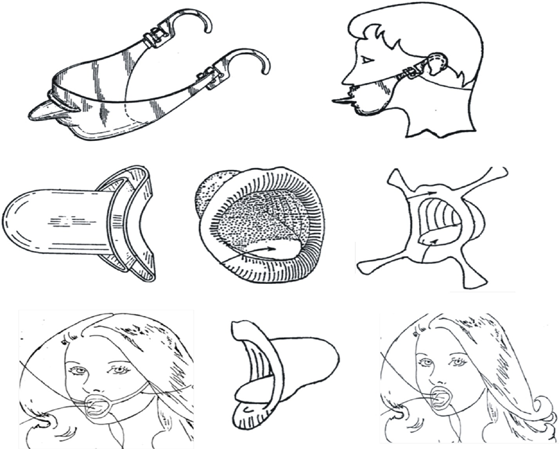 Figure 12: Design configuration of the prior patent for oral condom [48,49]