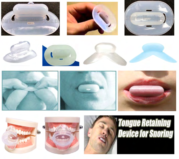 Figure 18: Shows the conventional snore pacifiers (special pacifier for adults or tongue stabilizing devices TSD or tongue retaining device) and their mode of application [62-64].