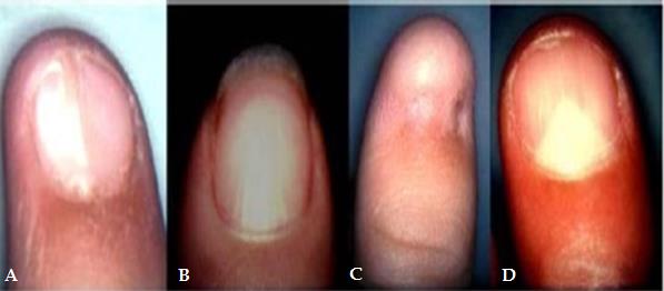 Figure 1: Dysplasia of the nails. A) Nail splinting B) Nail ridging C) Absent thumbnail D) Triangular lunula.