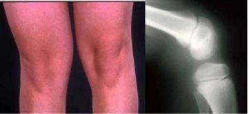 Figure 2: Hypoplastic or absent kneecaps (95%).