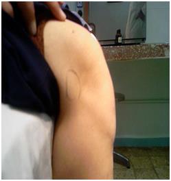 Figure 7: Subluxation of the radial head.