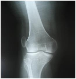 Figure 8: Nail pterygium in the father. For the other two cases, the family describes the same nail anomalies in the brother and sister aged 37 and 30, who are currently living abroad.