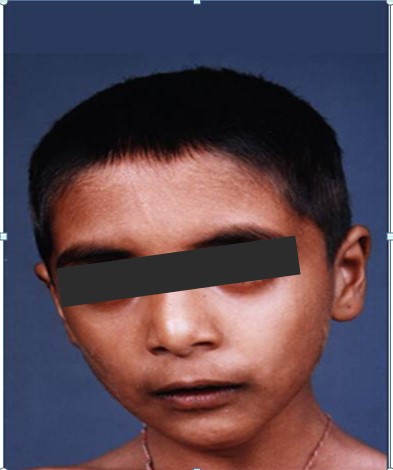 Figure 1: Facial features like hypertelorism, bushy eyebrows, folded epicanthal folds and beaked nose with the columella protruding well below the alae nasi can be seen.