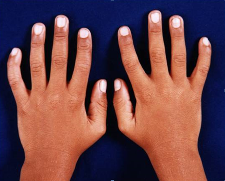 Figure 2: Photograph showing broad and medially deviated thumbs, clinodactyly of fifth little fingers in both hands.