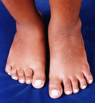 Figure 3: Broad great toes, clinodactyly of fifth toes in the right foot can be observed.
