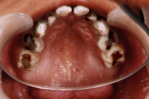Figure 5: Maxillary arch photograph showing high arched palate.