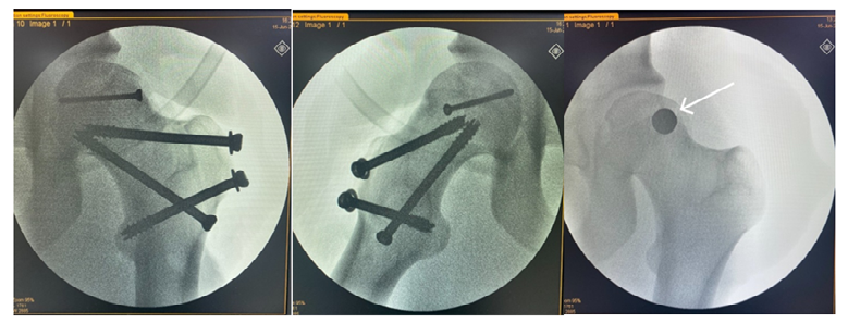Figure 2: Fluoroscopy showing the final result of the procedure.