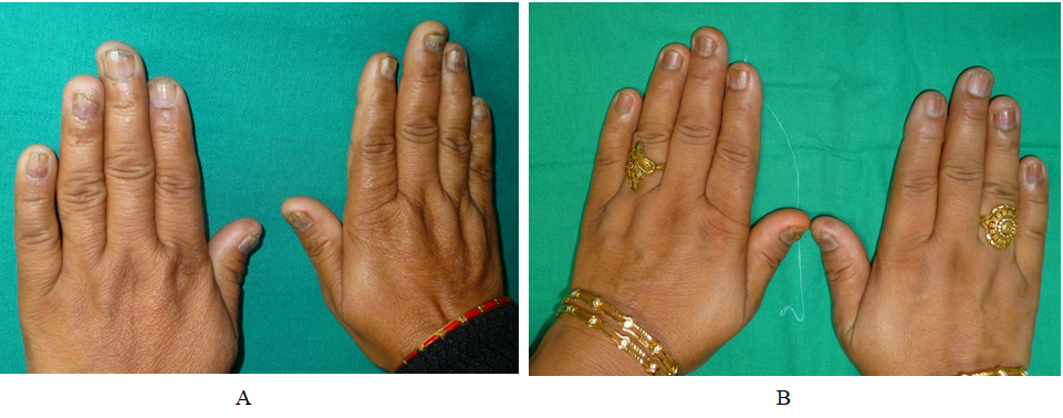 Figure 2: (A) Recalcitrant onychomycosis affecting all nails (B) Reduction in pigmentation, oncholysis and onychodystrophy after 8 laser sessions.
