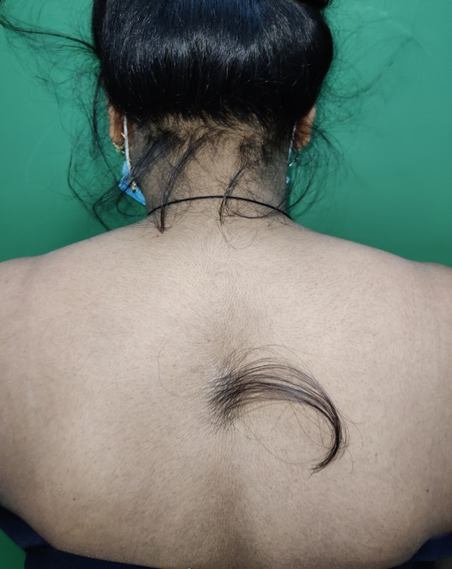 Figure 1: Isolated Faun Tail Nevus over mid-thoracic region.