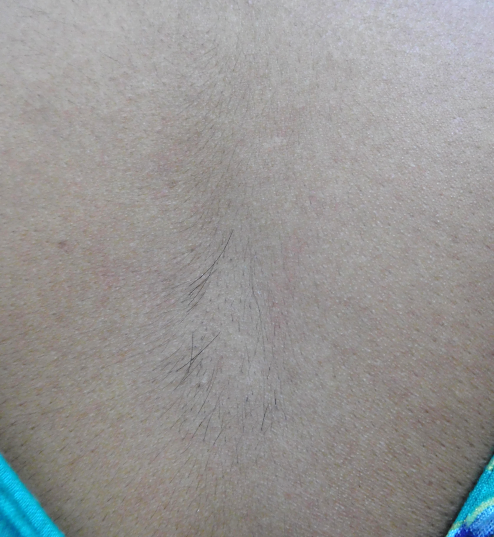 Figure 2: Isolated Faun tail nevus. Response after 6 sittings of triple wavelength laser.