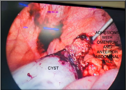 Figure 2: Mesentric Cyst having Adhesions with Omentum and Anterior Abdominal Wall.