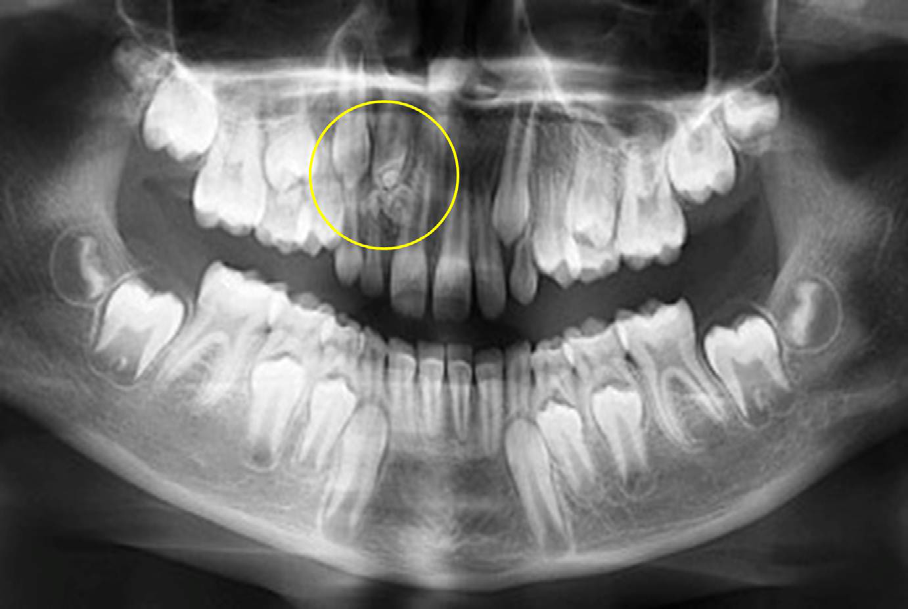 Figure 1: Orthopantomograph showing presence of complex odontome (yellow circle) in the maxillary right lateral incisor.