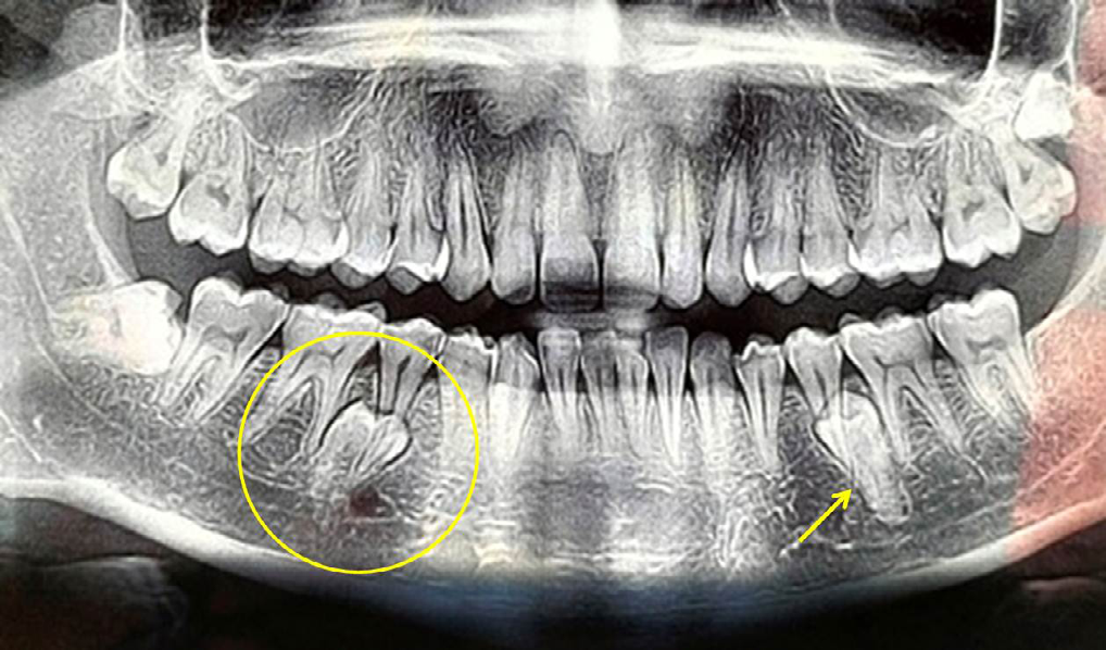Figure 2: Orthopantomograph showing compound odontome in the mandibular right premolar region (yellow circle). Presence of impacted supernumerary second premolar can also be seen in the right quadrant (yellow arrow).