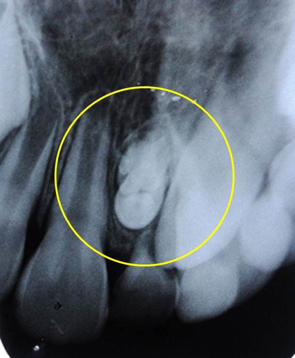 Figure 3: Intra-oral periapical radiograph showing complex odontome (yellow circle) in the maxillary left primary central and lateral incisors region.