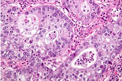 Figure 1: Adenosquamous carcinoma demonstrating glandular articulations layered with mucin secreting columnar epithelial cells imbued with eosinophilic cytoplasm, apical mucin and basal, hyperchromatic nuclei. Commingled are foci of squamous cell carcinoma with polygonal cells devoid of intercellular bridges [6].